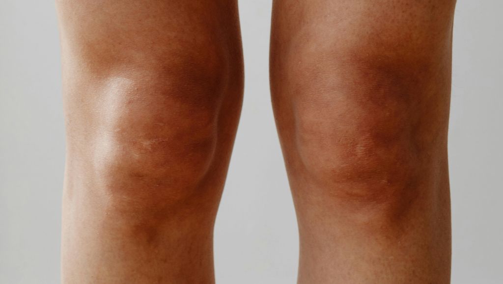 Liposukce kolen nabízí řešení problematického ukládání tuku v této partii